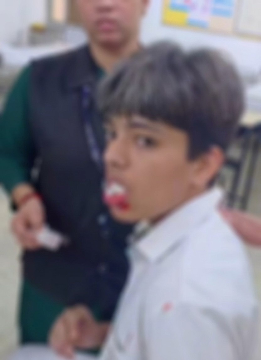 आगरा DPS मामला: छात्र का जबड़ा टूटने के कई दिनों बाद जागी पुलिस, आरोपी सहपाठी पर मुकदमा दर्ज, जांच शुरू